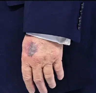 Bruise
